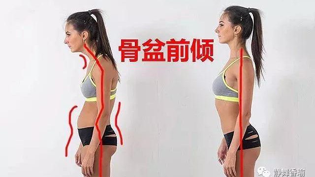 骨盆前倾的危险~如何通过瑜伽进行调理