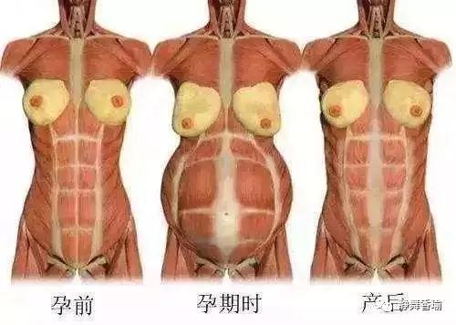 腹直肌如何修复？产后课题